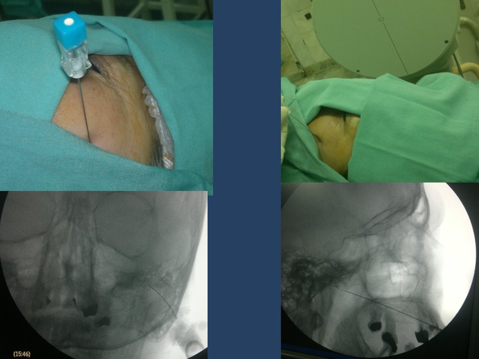 Neuralgia Esencial del Trigémino - Dr Guillermo Larrarte