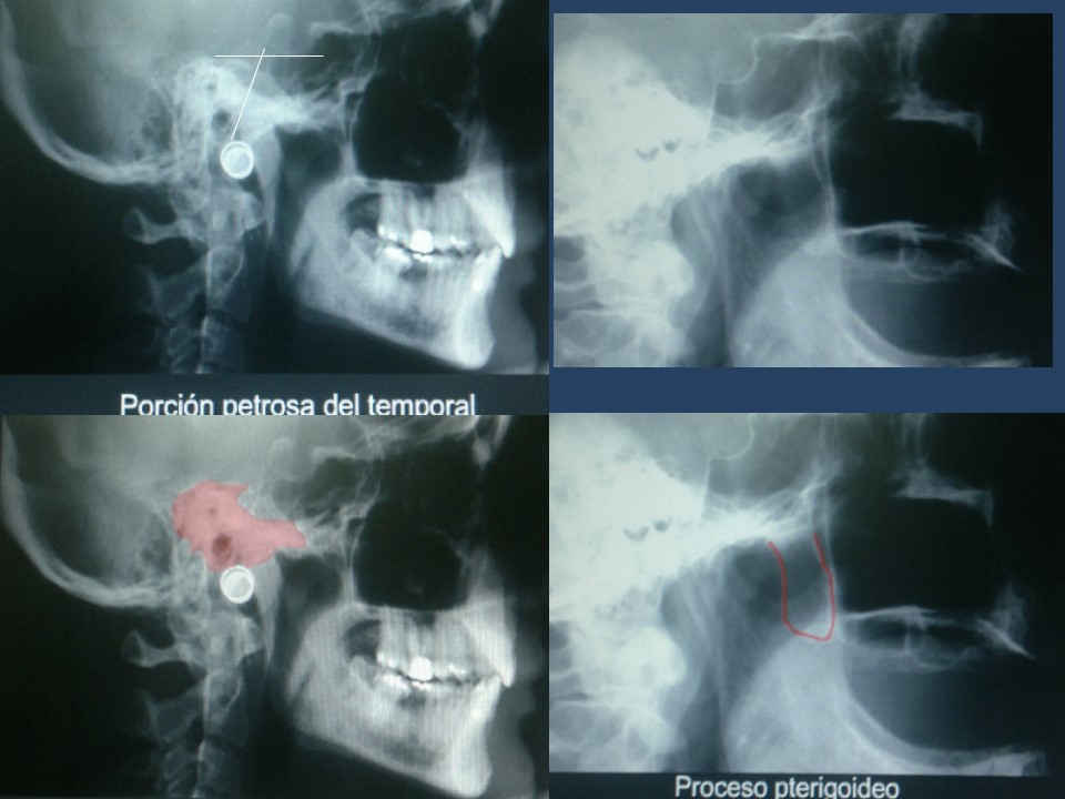 Neuralgia Esencial del Trigémino - Dr Guillermo Larrarte