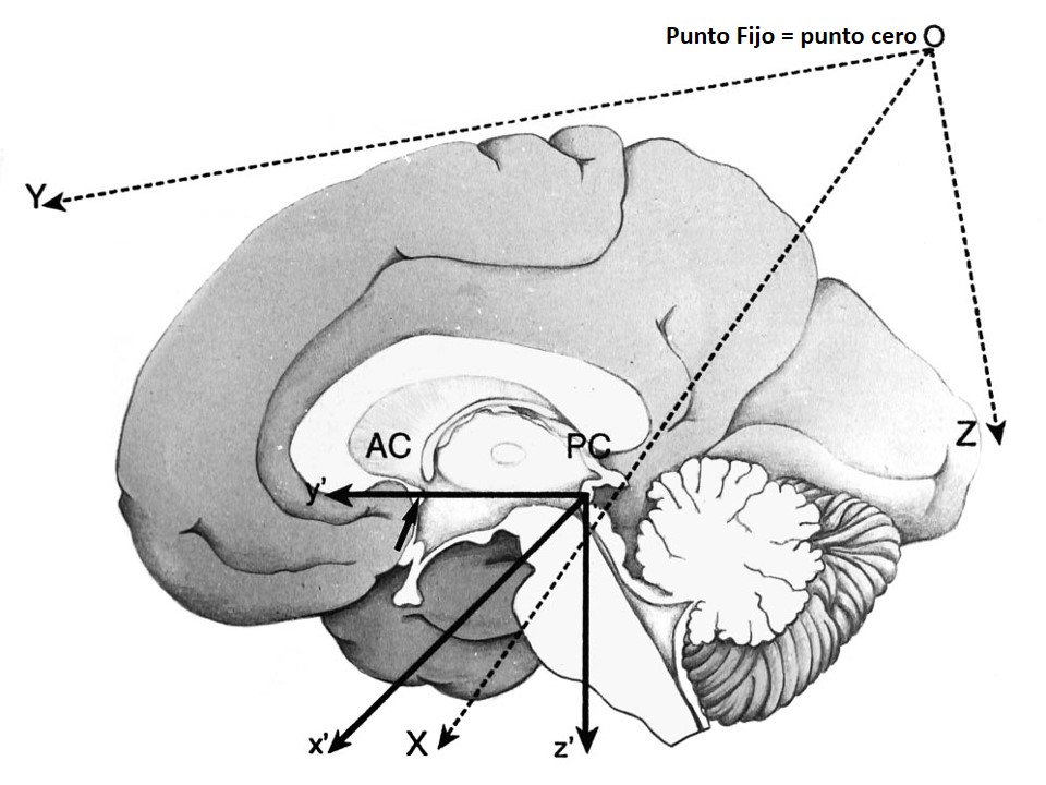 Metodología Estereotáctica o Estereotaxia - Dr Guillermo Larrarte