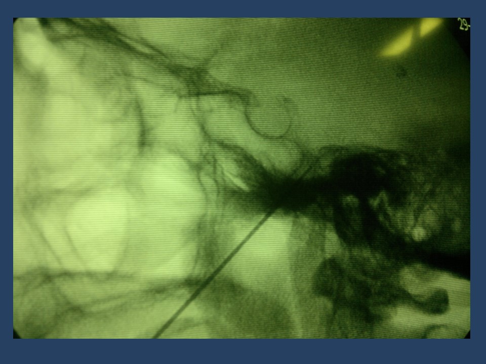 Neuralgia Esencial del Trigémino - Dr Guillermo Larrarte