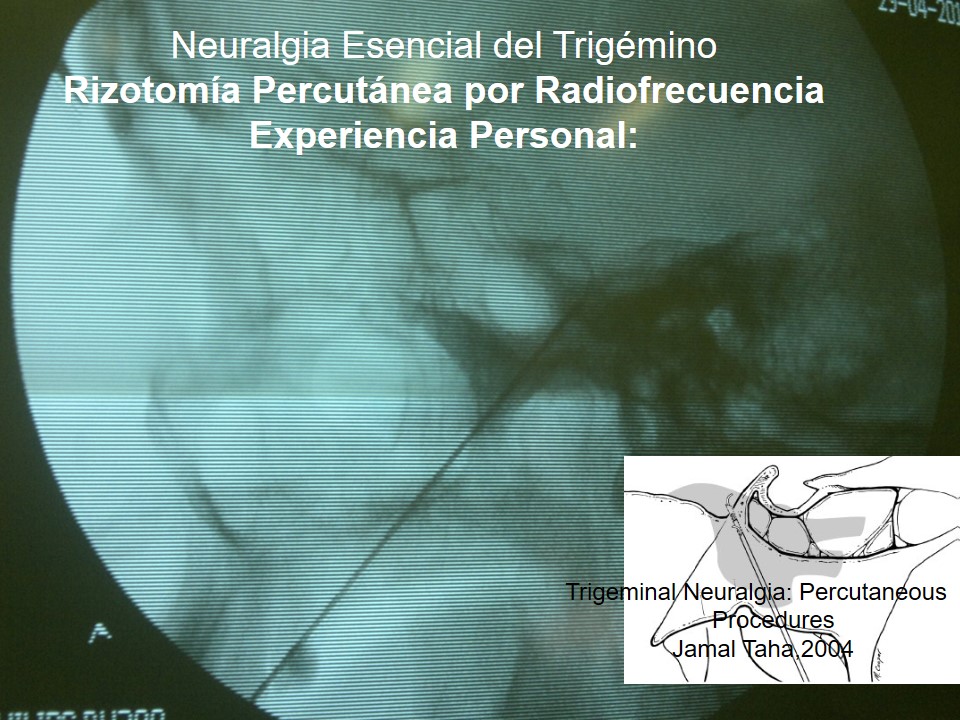Neuralgia Esencial del Trigémino - Dr Guillermo Larrarte