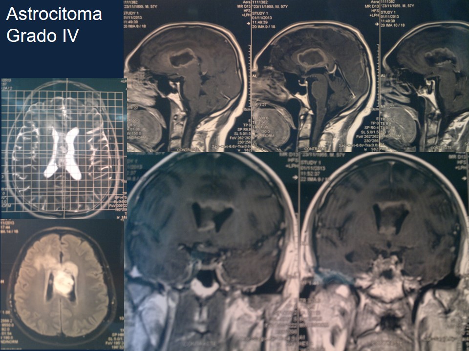 Metodología Estereotáctica o Estereotaxia - Dr Guillermo Larrarte
