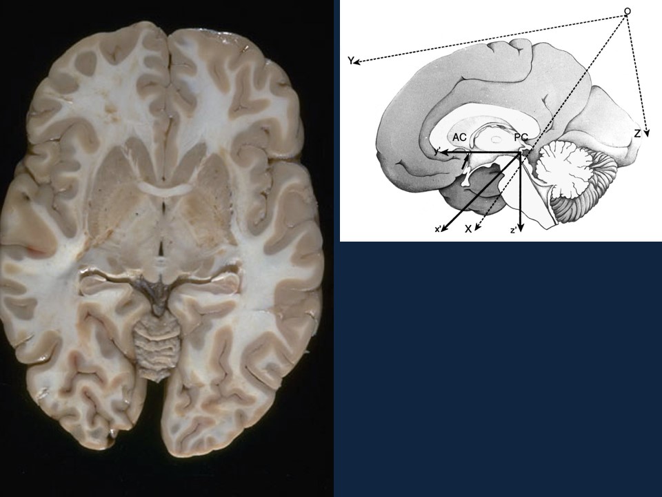 Metodología Estereotáctica o Estereotaxia - Dr Guillermo Larrarte
