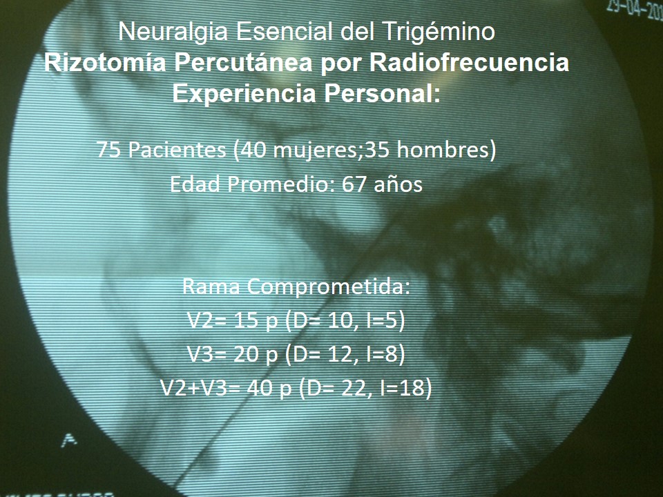 Neuralgia Esencial del Trigémino - Dr Guillermo Larrarte