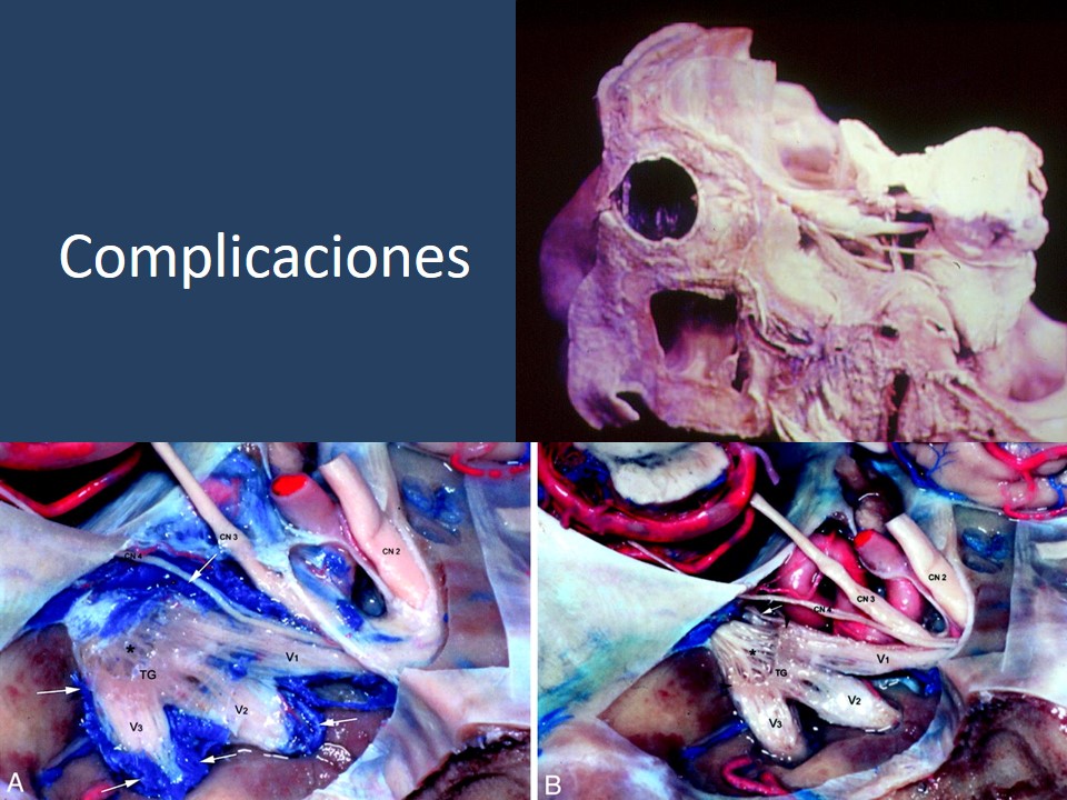 Neuralgia Esencial del Trigémino - Dr Guillermo Larrarte