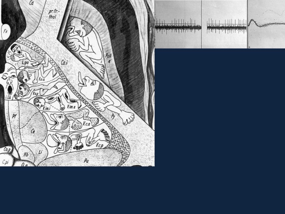 Metodología Estereotáctica o Estereotaxia - Dr Guillermo Larrarte