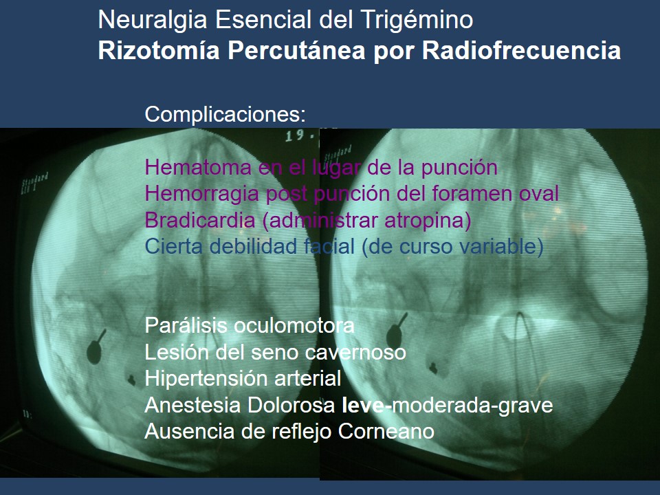 Neuralgia Esencial del Trigémino - Dr Guillermo Larrarte