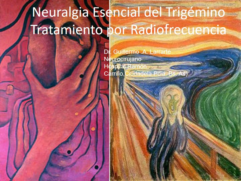 Neuralgia Esencial del Trigémino - Dr Guillermo Larrarte