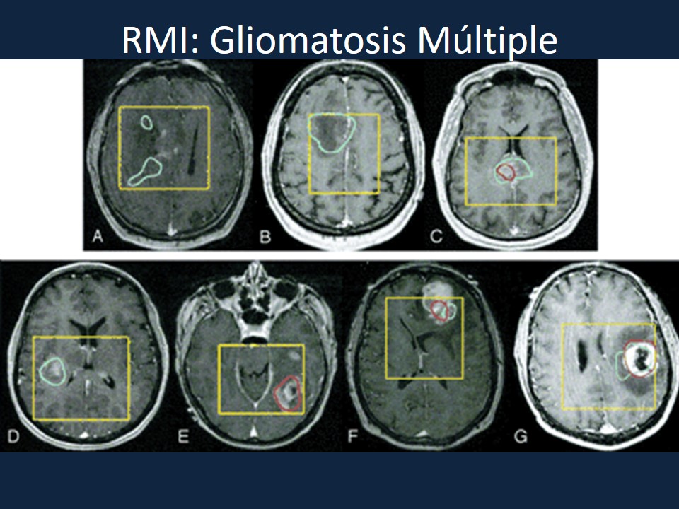 Metodología Estereotáctica o Estereotaxia - Dr Guillermo Larrarte