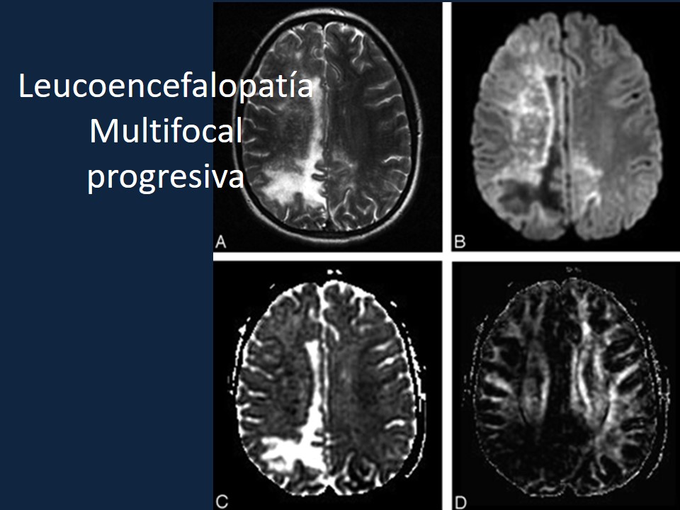 Metodología Estereotáctica o Estereotaxia - Dr Guillermo Larrarte