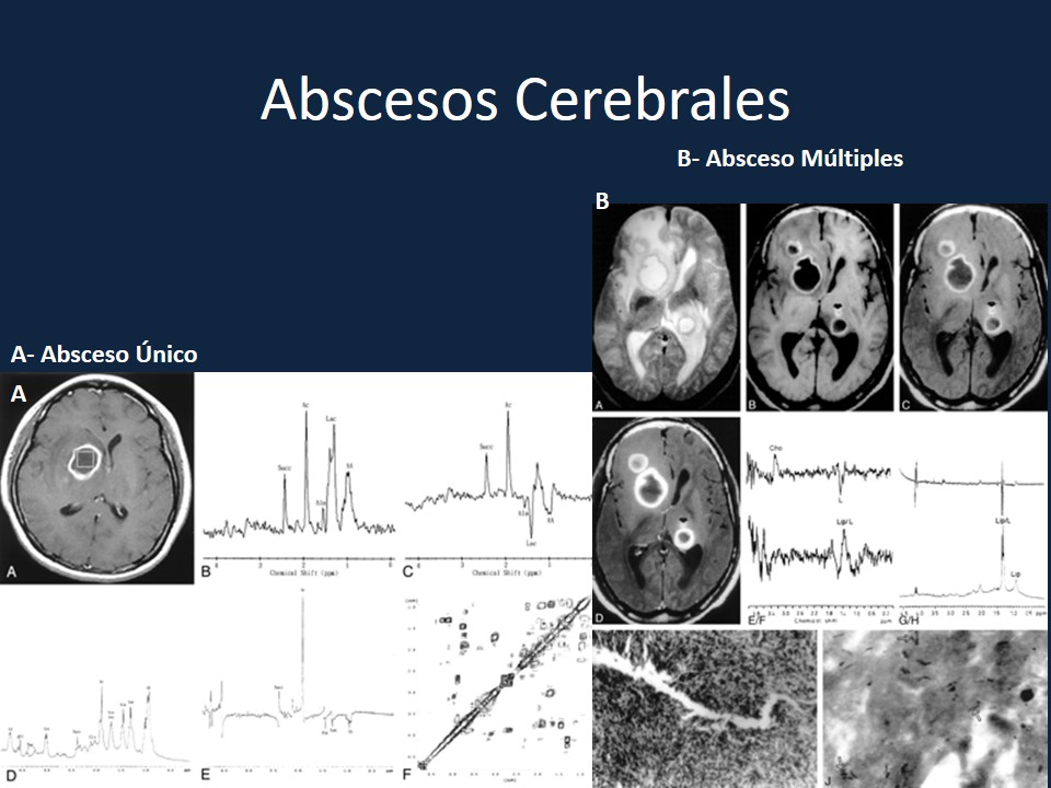 Metodología Estereotáctica o Estereotaxia - Dr Guillermo Larrarte