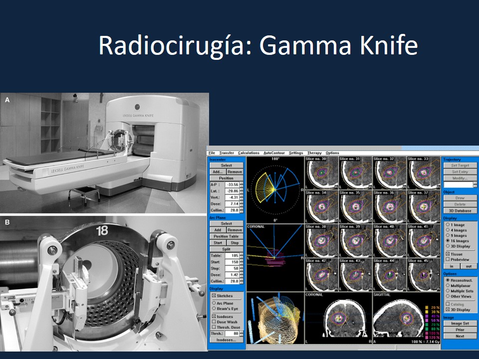 Metodología Estereotáctica o Estereotaxia - Dr Guillermo Larrarte