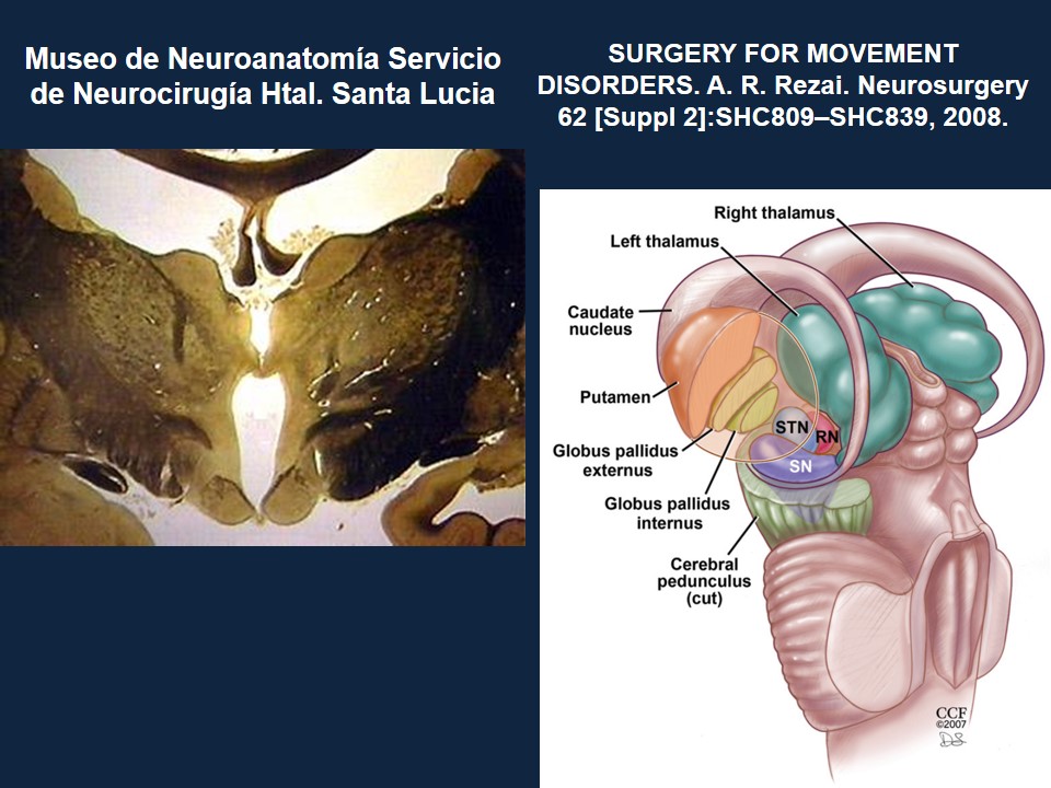 Metodología Estereotáctica o Estereotaxia - Dr Guillermo Larrarte