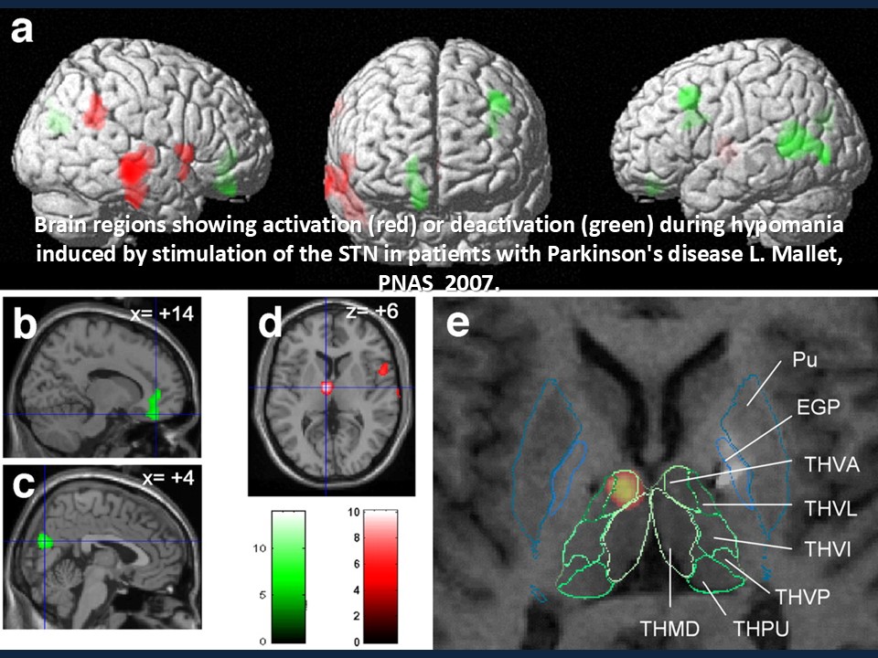 Metodología Estereotáctica o Estereotaxia - Dr Guillermo Larrarte