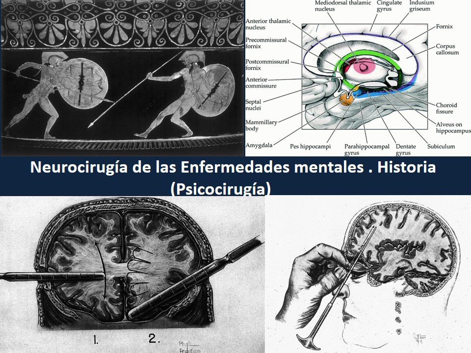 Metodología Estereotáctica o Estereotaxia - Dr Guillermo Larrarte