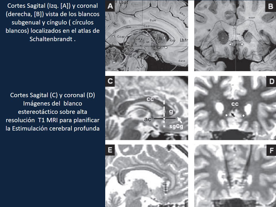 Metodología Estereotáctica o Estereotaxia - Dr Guillermo Larrarte