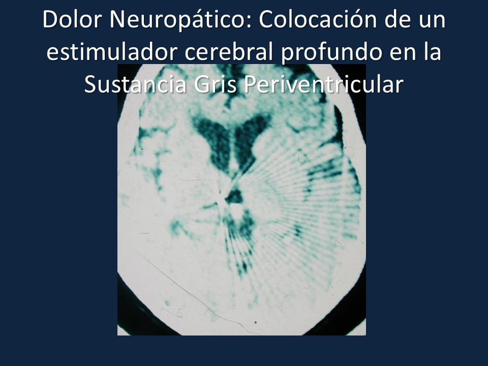 Metodología Estereotáctica o Estereotaxia - Dr Guillermo Larrarte