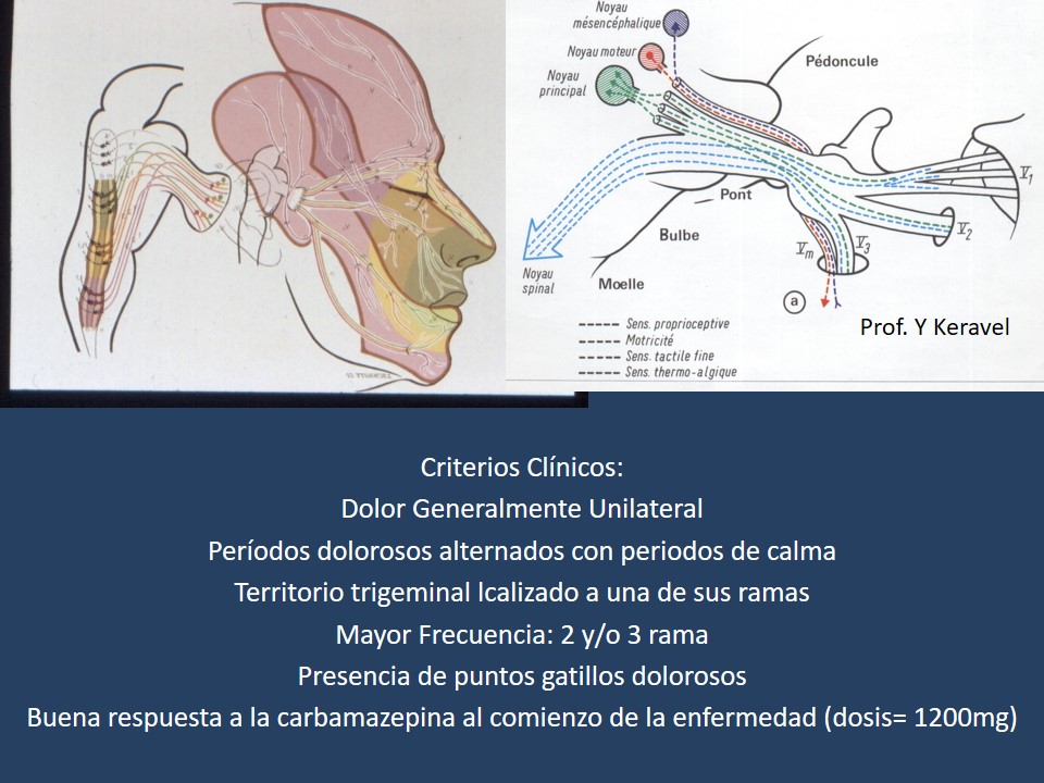 Neuralgia Esencial del Trigémino - Dr Guillermo Larrarte