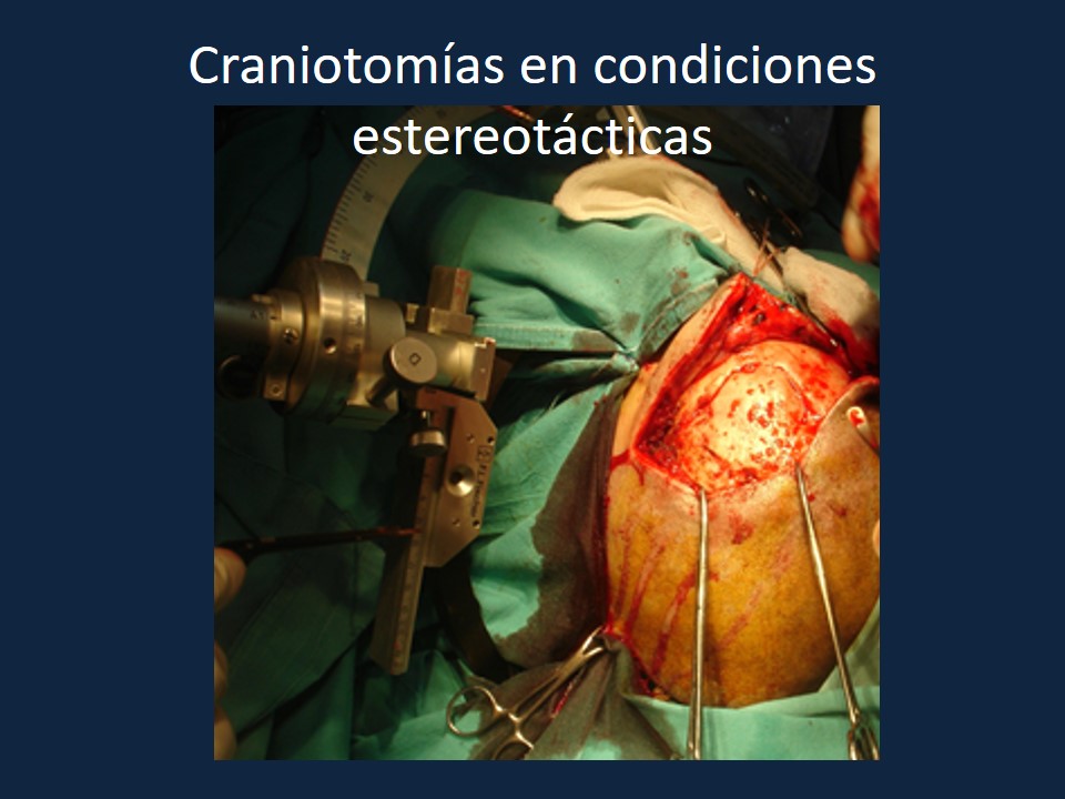 Metodología Estereotáctica o Estereotaxia - Dr Guillermo Larrarte