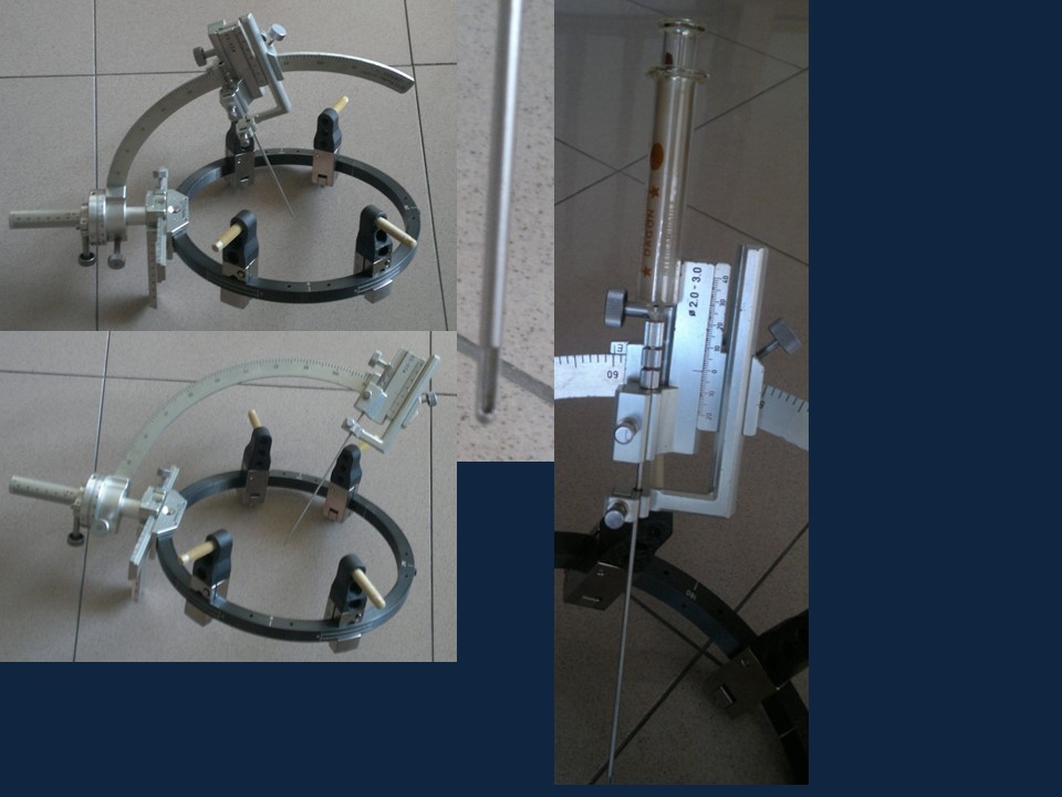 Metodología Estereotáctica o Estereotaxia - Dr Guillermo Larrarte