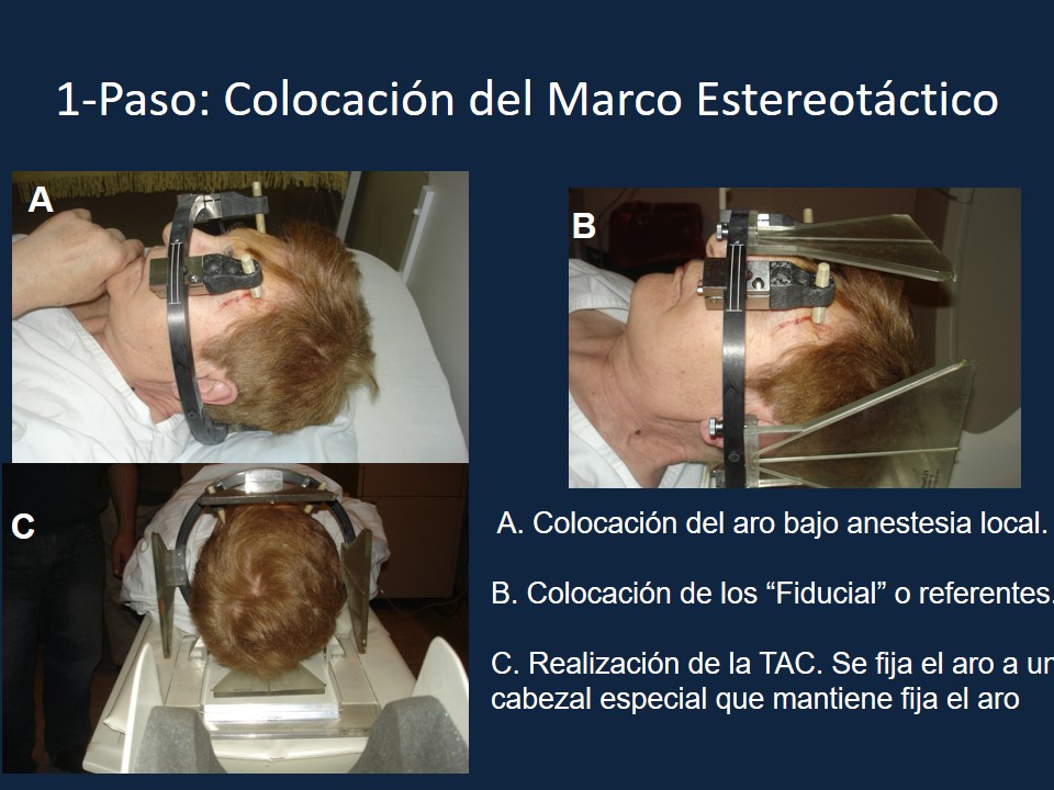 Metodología Estereotáctica o Estereotaxia - Dr Guillermo Larrarte