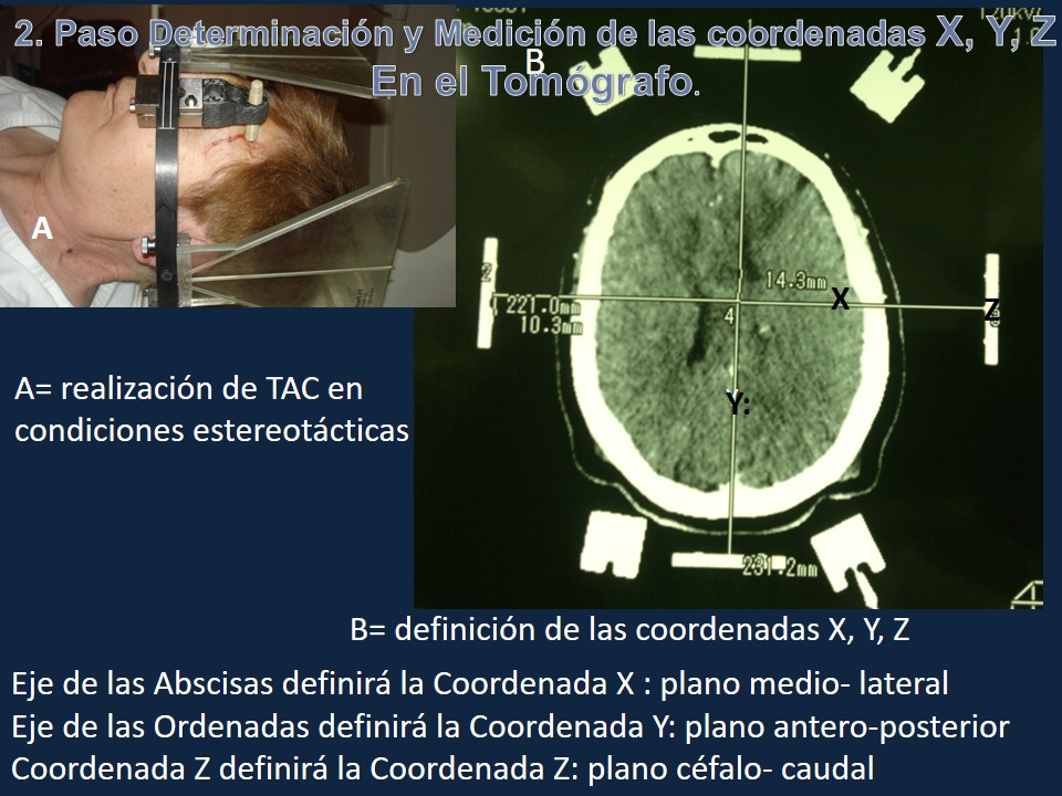 Metodología Estereotáctica o Estereotaxia - Dr Guillermo Larrarte