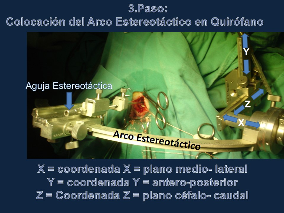 Metodología Estereotáctica o Estereotaxia - Dr Guillermo Larrarte