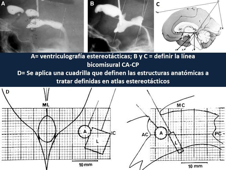 Metodología Estereotáctica o Estereotaxia - Dr Guillermo Larrarte