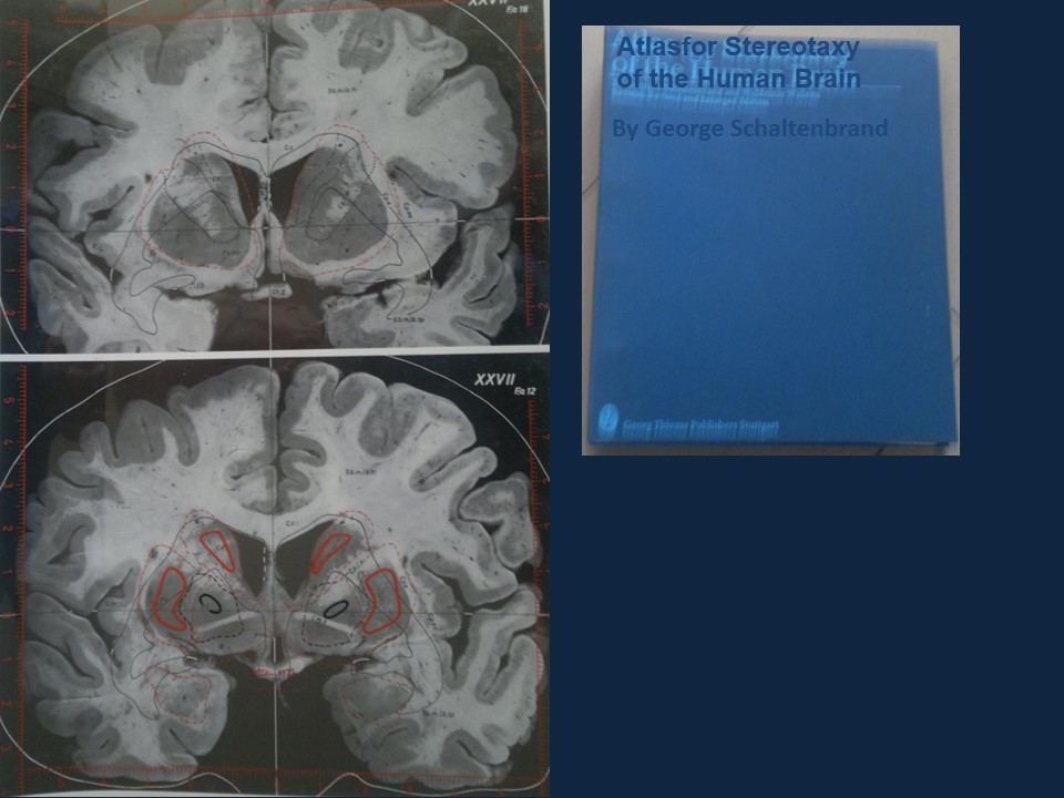 Metodología Estereotáctica o Estereotaxia - Dr Guillermo Larrarte