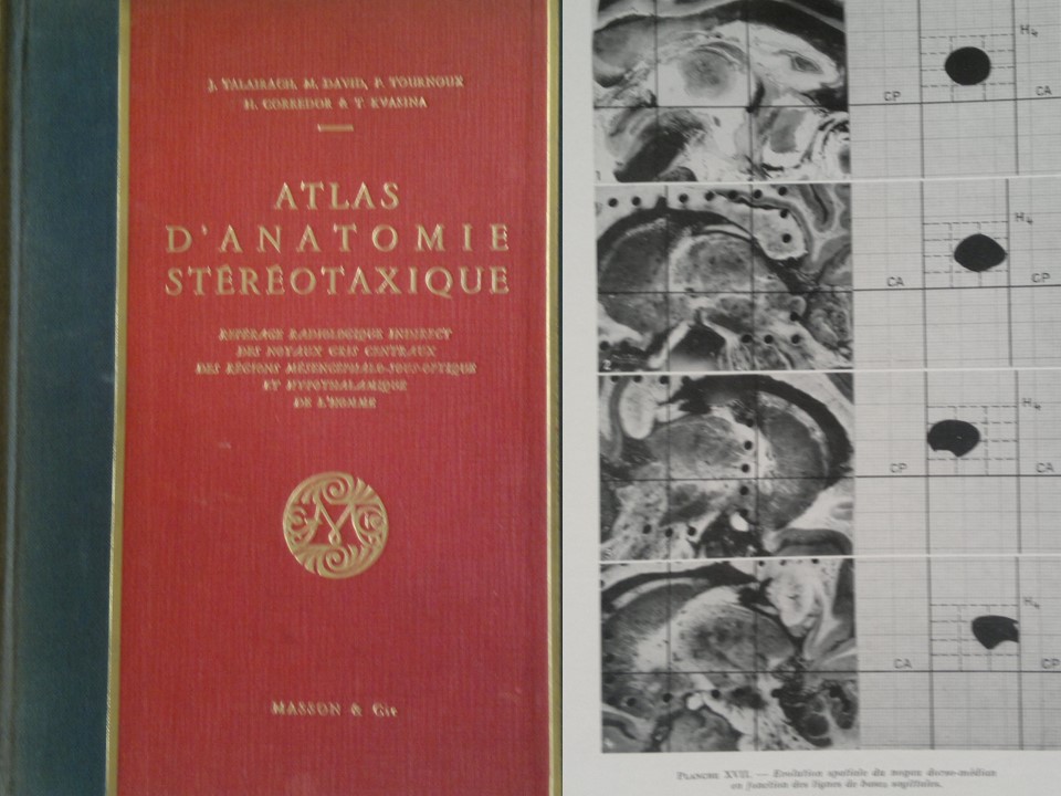 Metodología Estereotáctica o Estereotaxia - Dr Guillermo Larrarte