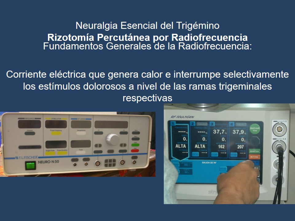 Neuralgia Esencial del Trigémino - Dr Guillermo Larrarte
