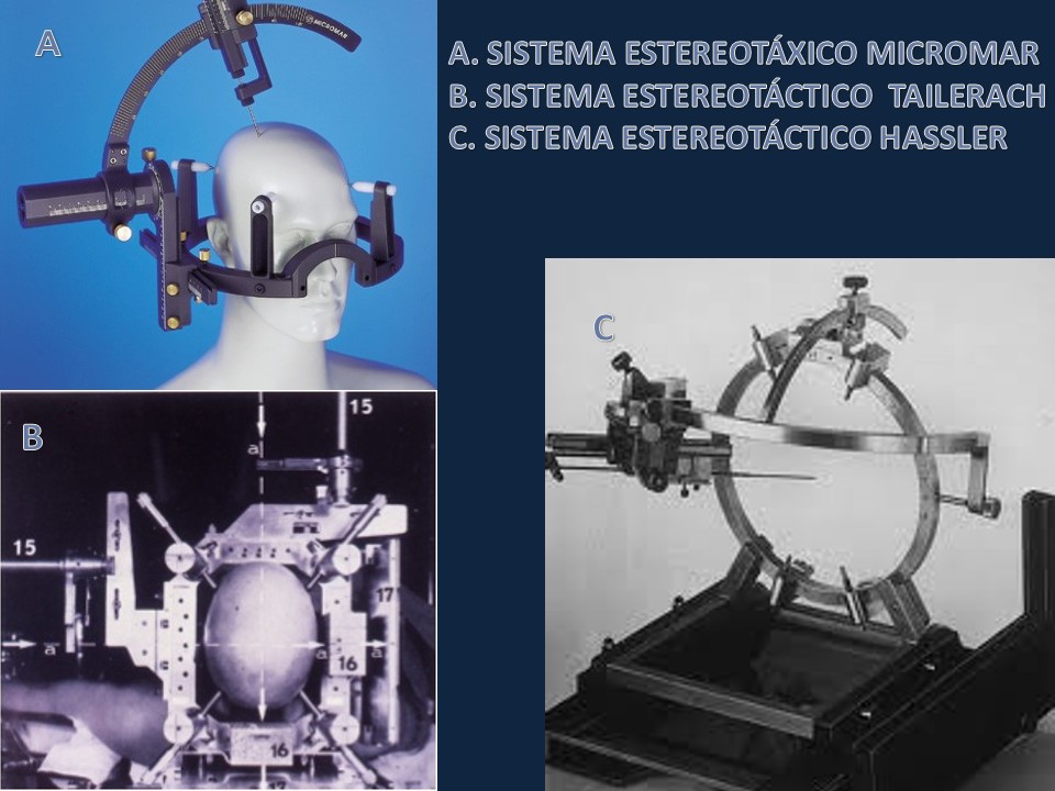 Metodología Estereotáctica o Estereotaxia - Dr Guillermo Larrarte